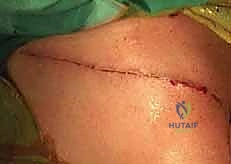 التشريح الجراحي لعظم الترقوة والأربطة المحيطة