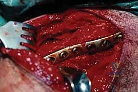 صورة توضيحية لـ تثبيت كسر الترقوة بالصفيحة والمسامير: دليل شامل للمرضى مع الأستاذ الدكتور محمد هطيف