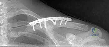 الأشعة السينية لتشخيص كسر الترقوة وتحديد درجة الإزاحة