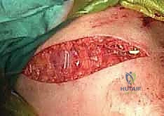 صورة توضيحية لـ تثبيت كسر الترقوة بالصفيحة والمسامير: دليل شامل للمرضى مع الأستاذ الدكتور محمد هطيف