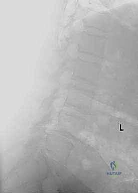 الأشعة السينية تظهر الانزلاق الفقاري والكسور