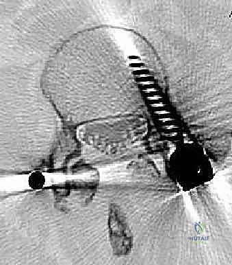الرنين المغناطيسي يوضح انضغاط الأعصاب