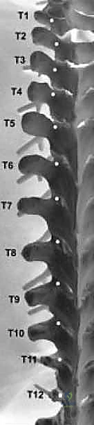 أدوات التثبيت في دمج الفقرات الصدرية القطنية