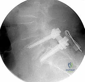 صورة طبية: دمج الفقرات الصدرية القطنية الخلفي الجانبي بالتثبيت بالأدوات: حل شامل لآلام الظهر وعدم الاستقرار