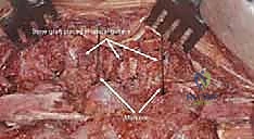 صورة توضيحية لـ دمج الفقرات الصدرية القطنية الخلفي الجانبي بالتثبيت بالأدوات: حل شامل لآلام الظهر وعدم الاستقرار