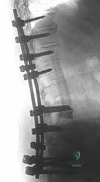 صورة طبية: دمج الفقرات الصدرية القطنية الخلفي الجانبي بالتثبيت بالأدوات: حل شامل لآلام الظهر وعدم الاستقرار