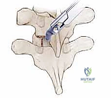 صورة توضيحية لـ دمج الفقرات الصدرية القطنية الخلفي الجانبي بالتثبيت بالأدوات: حل شامل لآلام الظهر وعدم الاستقرار
