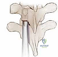 Illustration of posterolateral thoracolumbar fusion - Dr. Mohammed Hutaif