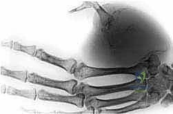 التحضير لجراحة بتر الطرف العلوي