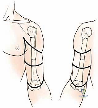 أنواع الأطراف الصناعية العلوية