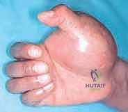 استعادة جودة الحياة بعد البتر