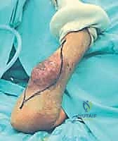 Illustration of aboveelbow and belowelbow - Dr. Mohammed Hutaif