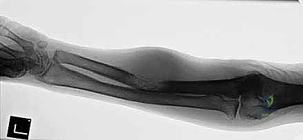 التشخيص الدقيق لأورام العظام