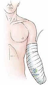 توضيح طبي لقرار بتر الأطراف العلوية في علاج الأورام السرطانية مع الأستاذ الدكتور محمد هطيف