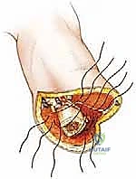 إدارة ألم الطرف الوهمي بعد البتر