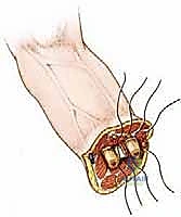 تشكيل الجذع بعد البتر