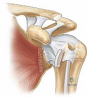 عوامل الخطر المؤدية إلى تيبس الكتف