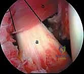 مقارنة نتائج العلاج التحفظي والجراحي