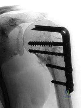 عملية الكي والقص الدقيق للأنسجة المتليفة باستخدام التردد الحراري