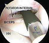 تطبيق العلاج التحفظي والعلاج الطبيعي للكتف