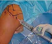 صورة توضيحية لـ تحرير محفظة الكتف بالمنظار: حل فعال لتيبس الكتف واستعادة الحركة مع الأستاذ الدكتور محمد هطيف