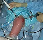 فحص الألم والتيبس في مفصل الكتف