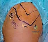 الأستاذ الدكتور محمد هطيف أثناء إجراء عملية دقيقة بالمنظار