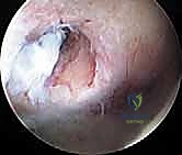 أدوات المنظار الجراحي الدقيقة المستخدمة في تحرير المحفظة