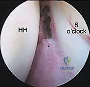 صورة من داخل المفصل توضح الأنسجة المتليفة قبل التحرير