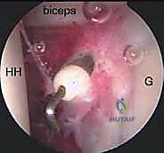 تمارين التقوية والمرونة في المراحل المتقدمة من التأهيل