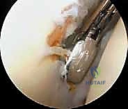 صورة توضيحية لـ تحرير محفظة الكتف بالمنظار: حل فعال لتيبس الكتف واستعادة الحركة مع الأستاذ الدكتور محمد هطيف