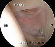 استخدام الرنين المغناطيسي لتشخيص تيبس الكتف
