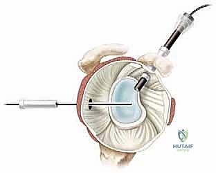 صورة توضيحية لـ تحرير محفظة الكتف بالمنظار: حل فعال لتيبس الكتف واستعادة الحركة مع الأستاذ الدكتور محمد هطيف