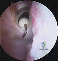 صورة توضيحية لـ تحرير محفظة الكتف بالمنظار: حل فعال لتيبس الكتف واستعادة الحركة مع الأستاذ الدكتور محمد هطيف