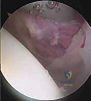 تحرير محفظة الكتف بالمنظار: حل فعال لتيبس الكتف واستعادة الحركة مع الأستاذ الدكتور محمد هطيف