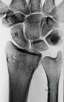 الشق الجراحي الدقيق وإبعاد الأوتار