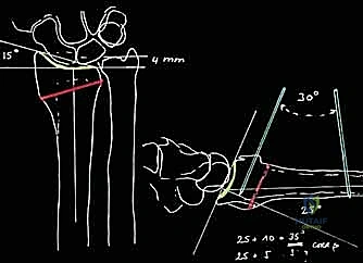 إجراء القص العظمي باستخدام منشار دقيق