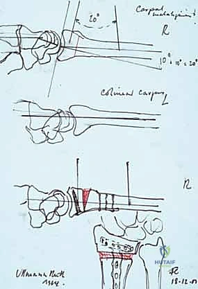 الوصول إلى العظم المشوه بأمان