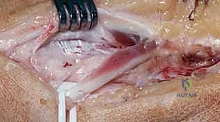 صورة توضيحية لـ تشوه الكعبرة البعيدة