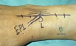 تثبيت الشريحة التيتانيوم المبدئي