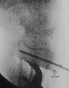 صورة طبية: عملية تصحيح تشوه الكعبرة البعيدة: استعادة دقيقة لوظيفة الرسغ مع الأستاذ الدكتور محمد هطيف في صنعاء