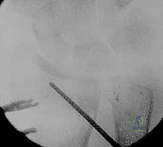 التشريح الدقيق لمفصل الرسغ وتأثير التشوه