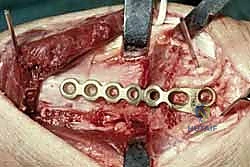 تحديد مكان القص العظمي بدقة