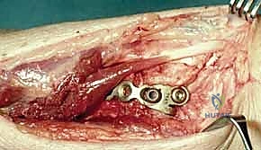 فتح العظم وتعديل الزاوية