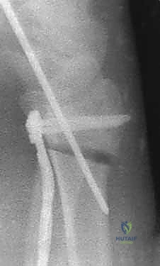 صورة توضيحية لـ عملية تصحيح تشوه الكعبرة البعيدة: استعادة دقيقة لوظيفة الرسغ مع الأستاذ الدكتور محمد هطيف في صنعاء