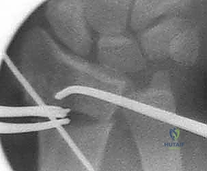 صورة طبية: عملية تصحيح تشوه الكعبرة البعيدة: استعادة دقيقة لوظيفة الرسغ مع الأستاذ الدكتور محمد هطيف في صنعاء