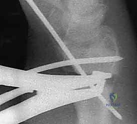 صورة توضيحية لـ عملية تصحيح تشوه الكعبرة البعيدة: استعادة دقيقة لوظيفة الرسغ مع الأستاذ الدكتور محمد هطيف في صنعاء