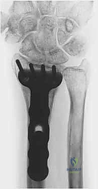 صورة طبية: عملية تصحيح تشوه الكعبرة البعيدة: استعادة دقيقة لوظيفة الرسغ مع الأستاذ الدكتور محمد هطيف في صنعاء