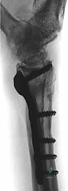 صورة طبية: عملية تصحيح تشوه الكعبرة البعيدة: استعادة دقيقة لوظيفة الرسغ مع الأستاذ الدكتور محمد هطيف في صنعاء