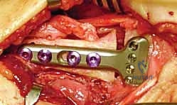 صورة طبية: عملية تصحيح تشوه الكعبرة البعيدة: استعادة دقيقة لوظيفة الرسغ مع الأستاذ الدكتور محمد هطيف في صنعاء